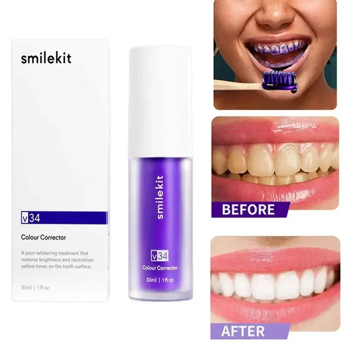 BrightSmile - Teeth Whitening Smilekit